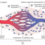 Inflammation