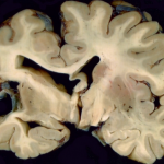 Nekrose i hjernen