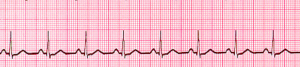 Normalt EKG