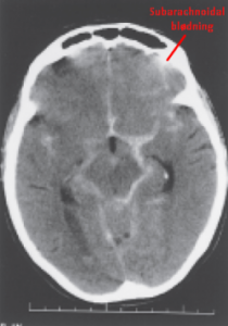 250px-ct-subarachnoidal-bloedning