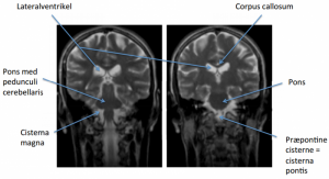 MR-scanning posterior/anterior