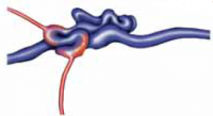 arteriovenoes-malformation