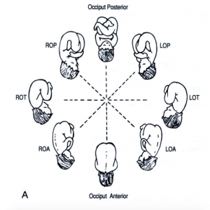 Caputs rotation (L = left, R = right, OP = Occiput posterior, OA = Occiput anterior, OT = Occiput transverse)