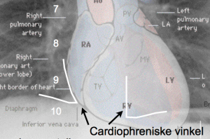 cardiophreniske-vinkel