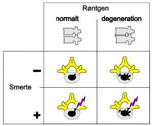 diskusdegeneration-smerter