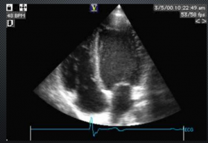 Ekkokardiogram