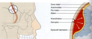 Epidural blødning pga. traume i tindingeregionen hvor a. meningea media er revet over.