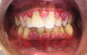 Gingival hyperplasi