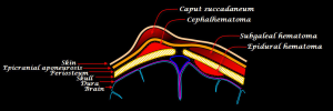 Kefalhæmatom 