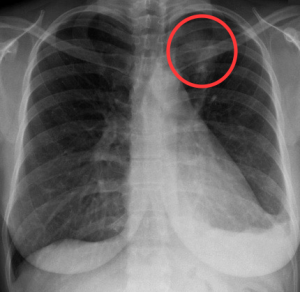 Lungecancer i venstre lunge. Der ses også pleuravæske i bunden af venstre lunge
