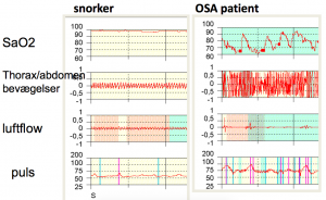 Forskel mellem snorken og obstruktiv søvnapnø