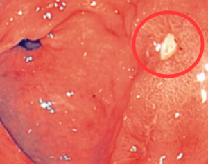 Præpylorisk ulcus ses markeret med rød ring. Er fibrinbelagt. Pyloris ses i venstre side.