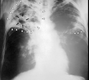 Tuberkulose (Røntgen)