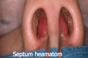Septum haematom