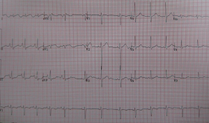 Sinus arytmi