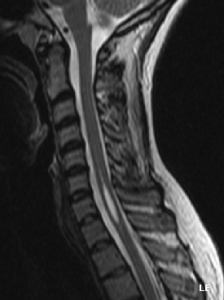 Syringomyelia