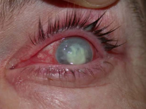 Keratitis