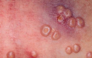 Molluscum contagiosum