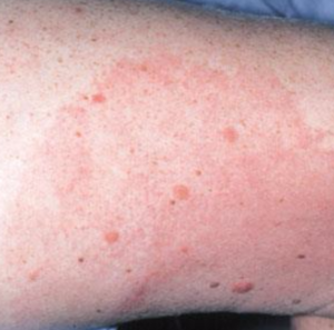 Erythema migrans