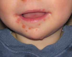 Hand-foot-and-mouth  disease