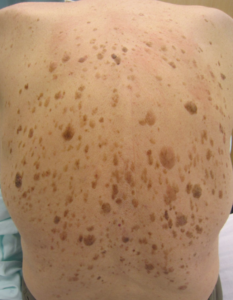 Keratosis seborrhoica