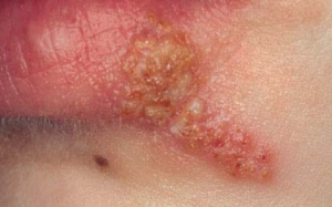 Herpes labialis