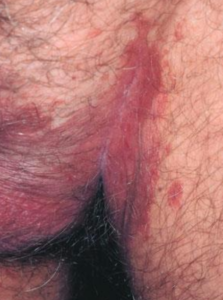 Invers psoriasis